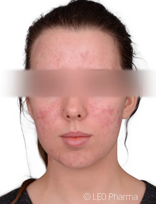 Acne Treatment Before & After 3