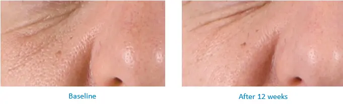 Reducing pore size