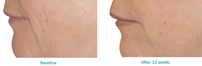 Inducing Collagen Production